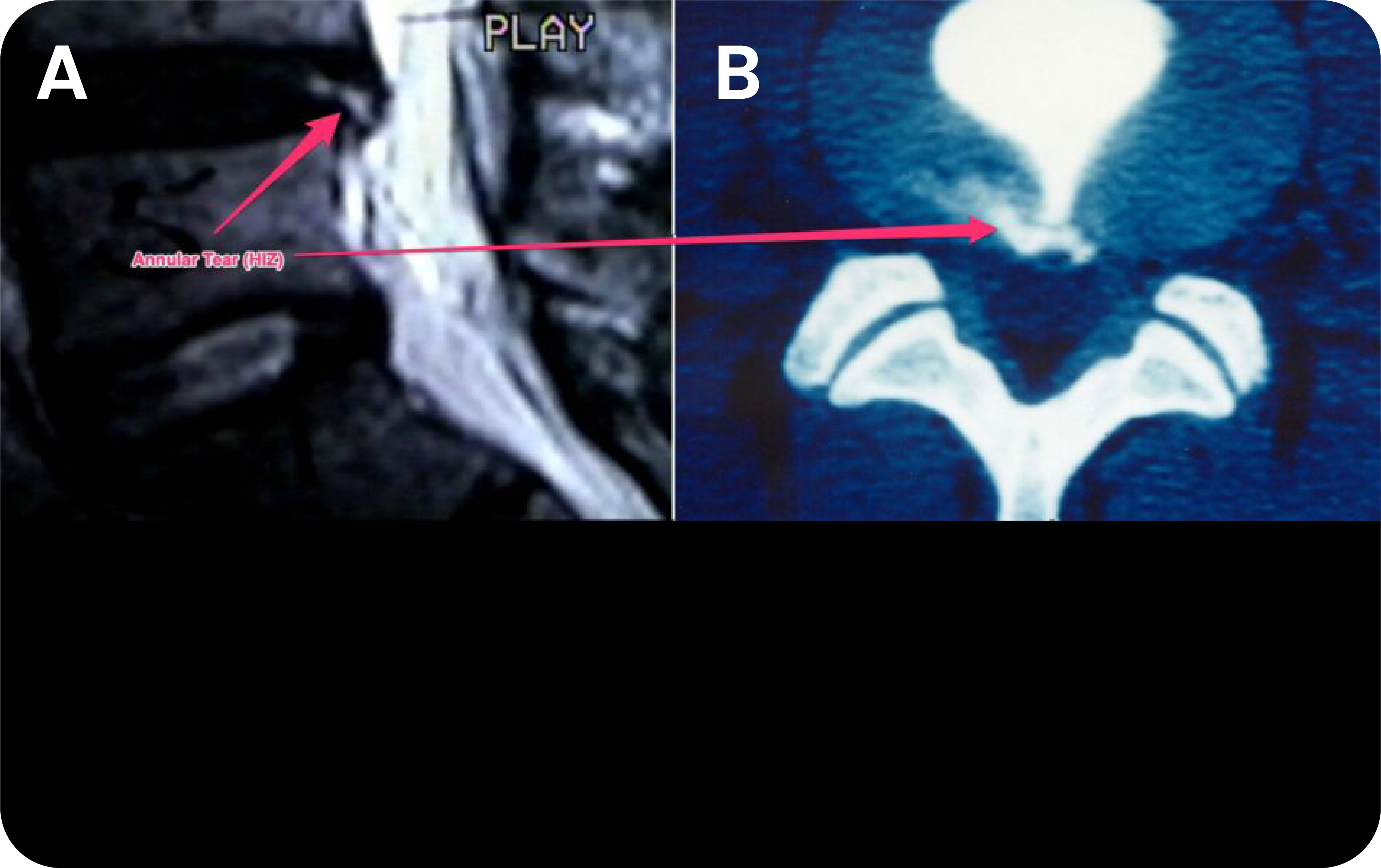 Fig.1 Annular tear of lumbar inter-vertebral disc.